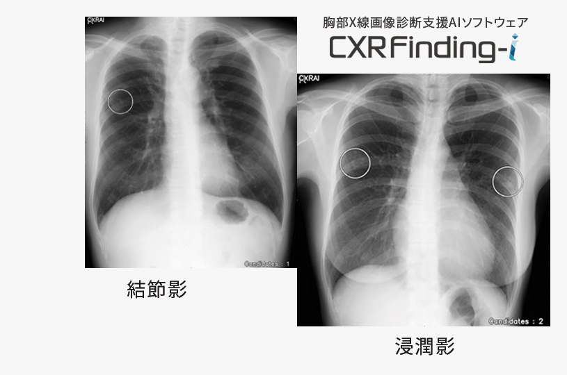  胸部X線画像診断支援AIソフトウェア