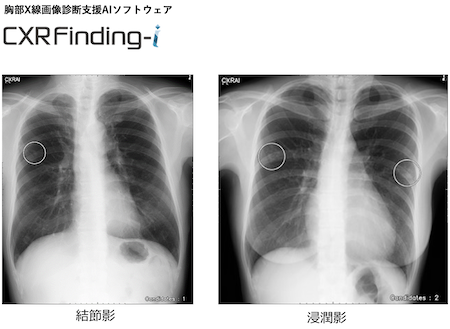 胸部X線画像診断とは