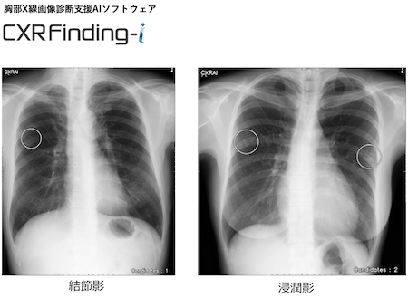 胸部X線画像診断 - 健康診断・検査・予防接種の専門サイト｜渚たなの 